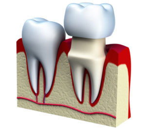 Dental Crowns Bellingham WA