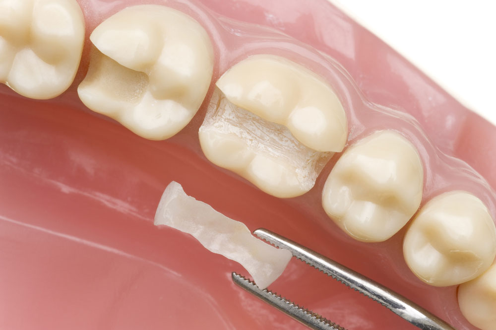 Dental Restoration Bellingham WA